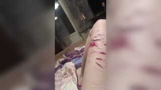 Intoxicated Woman Shows Her Recent Leg Wounds