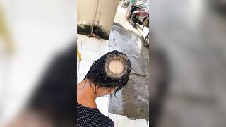 Homeless Woman Literally Has Her SKULL Exposed