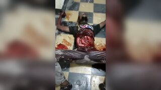 Cameroonian man stolen intestine