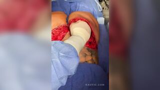 Butt Implant Gone Bad