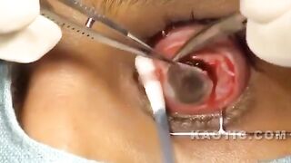 Eyeball removal surgery.