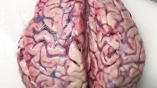 Brain cut in Half to Reveal Blood Clot