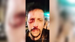 Man Loses Eye After Being Mistaken For a Thief