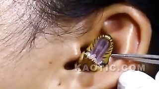 Snake inside woman's ear.