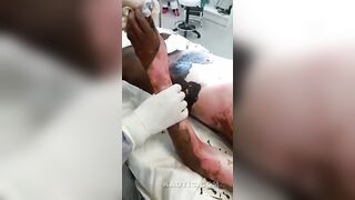 Pealing skin off of a burn victim.