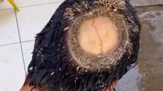 Serious head wound leaves skull visible and infested with Maggots