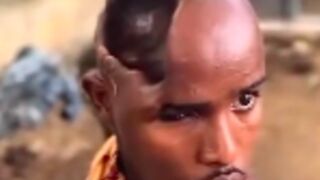 Man still alive with half his Brain missing - Somalia
