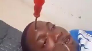 Young man had his head penetrated with a screwdriver