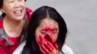 Woman's face was left disfigured after moped accident in China