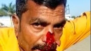 Man loses his nose in a motorcycle accident, India