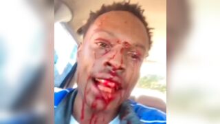 Man goes on Live after getting shot in the forehead in Baton Rouge