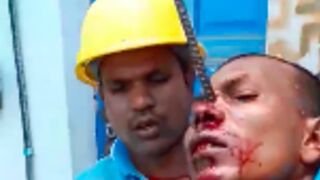 Accident leaves worker looking like a unicorn after an Iron rod got stuck in his face