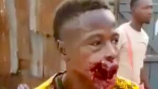 Protester in Senegal walks around with an open face after getting shot in the mouth by police