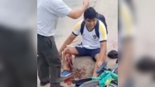 Man got his leg torn open in a bicycle accident