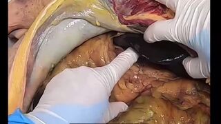 Autopsy of a Fat Man - NSFW