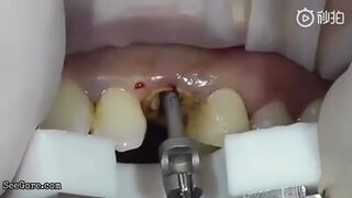 Dentists Pulls Tooth