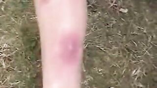 Staph infection popping
