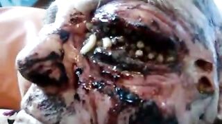 Old Woman's Eye Socket teeming with Maggots