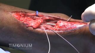 Achilles Tendon Repair