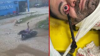 Moped rider gets his eye penetrated by mirror stem during minor accident - Brazil