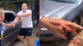 Man gets his hand chopped with a machete during fight with neighbors - Mexico