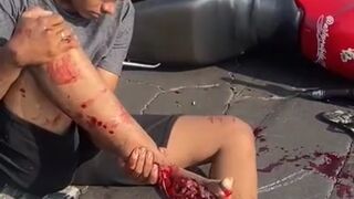 Motorcyclist has his foot mutilated after getting involved in an accident while wearing flip-flops - Brazil