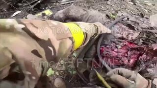 Feel the pain. Ukrainian's leg turned into meat after stepping on a mine