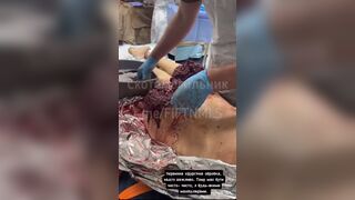 Anus reconstruction surgery on a Ukrainian soldier