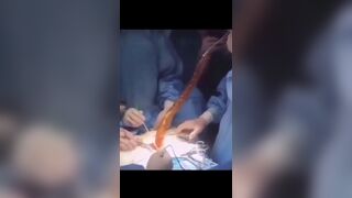 Snake Dildo Removed from Man's Intestine - gross!