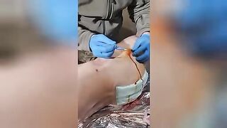 Surgeons remove the bullet from the thigh