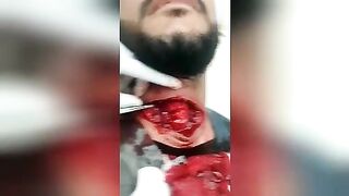 Doctors save the life of a man with a slit throat