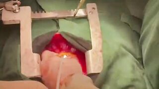 The surgeon removes a fragment from a beating heart