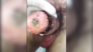 Gangrenous inflammation of a penis