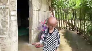 Girl with severe hydrocephalus. Deformities and mutations