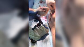 A guide on how to remove a fragment of a Russian bomb from the ass of a wounded Ukrainian.